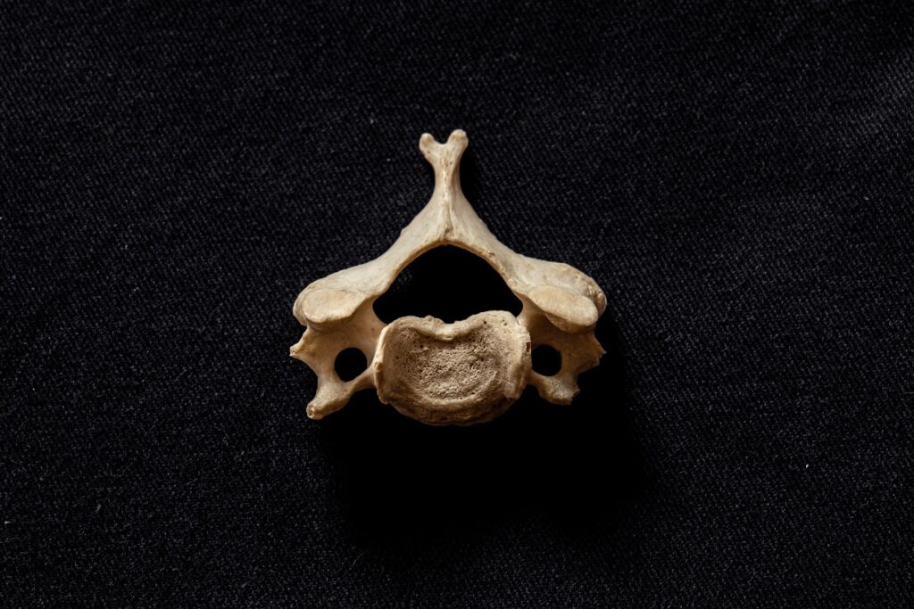 Typical C3-6, human cervical vertebra , bifid spinous process clearly visible
